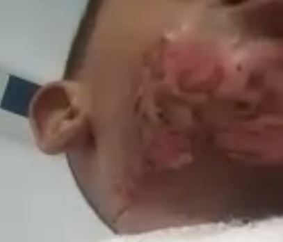 Niño con su cuerpo quemado, supuestamente por su tía