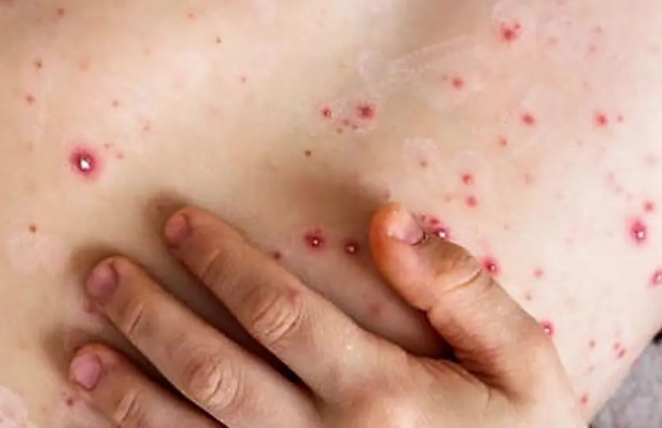 NYC reporta el primer caso de Mpox